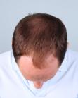 After Hair Transplant &nbsp;Midscalp